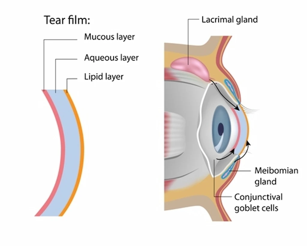 Meibomian Gland Dysfunction (MGD) Treatment in Chicago, IL Kraff Eye